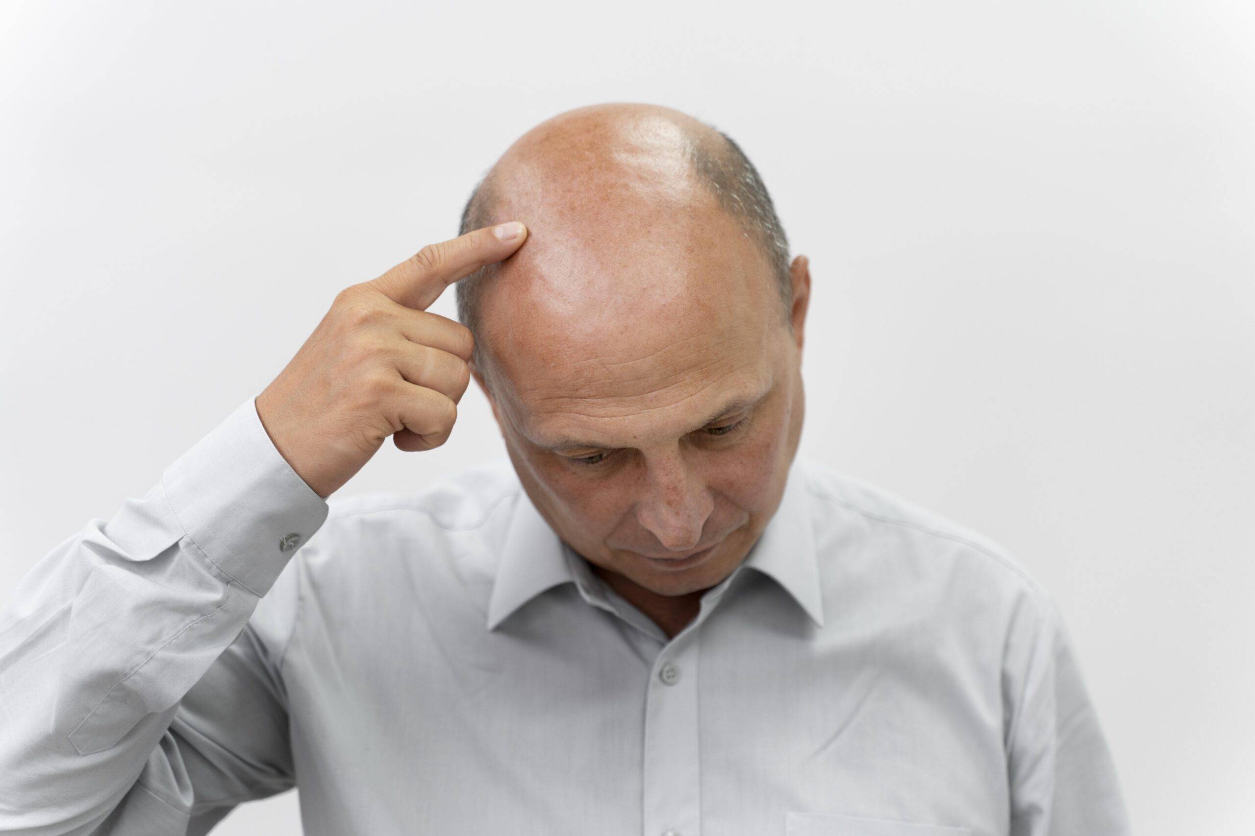 Understanding Alopecia: Causes, Types, and Treatments 1 alopecia
